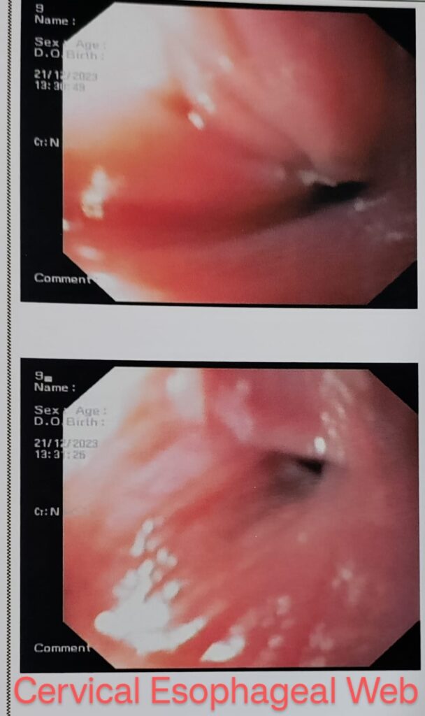 cervical-esophageal-web