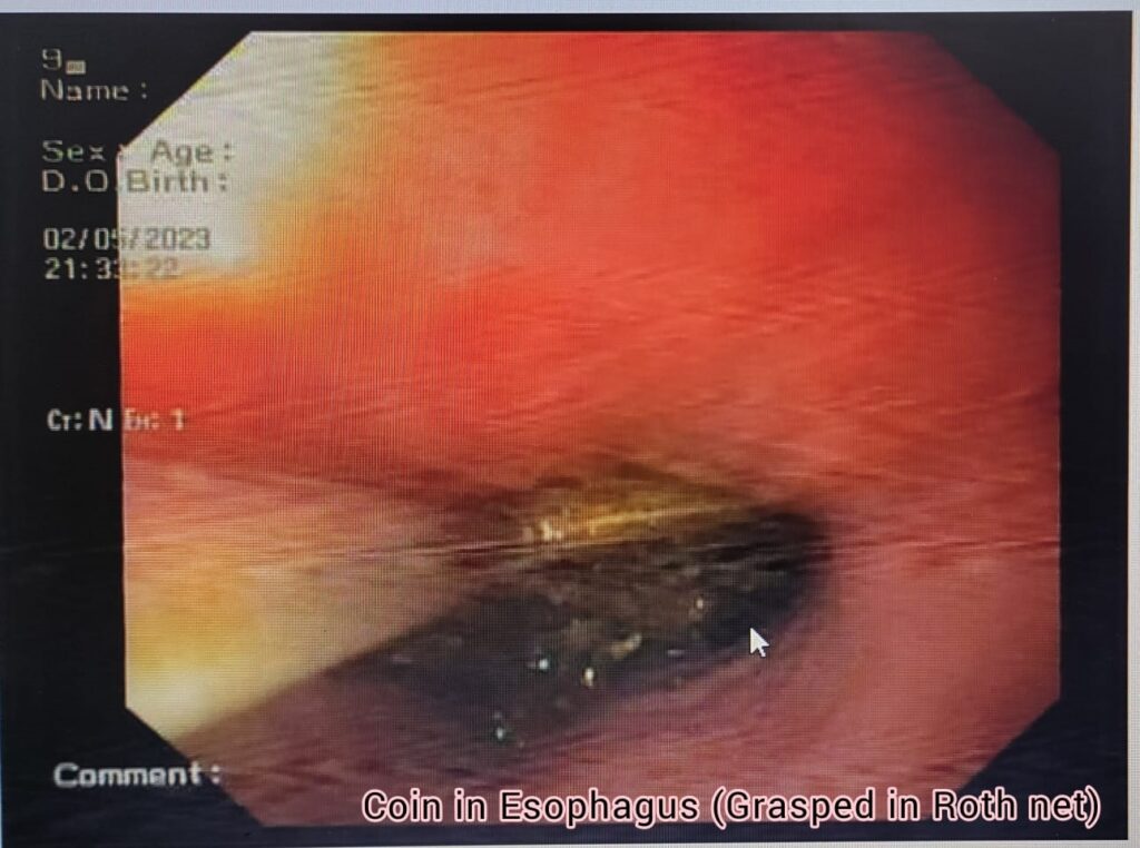 Coin in Esophagus-Grasped in Roth net