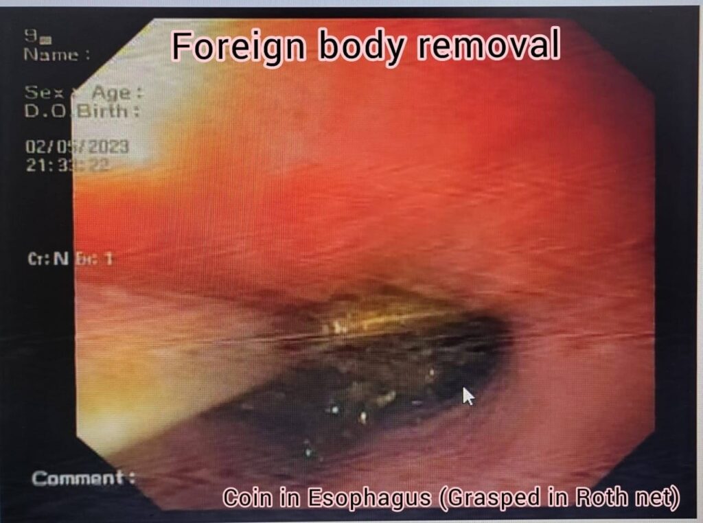 Coin in Esophagus-Grasped in Roth net