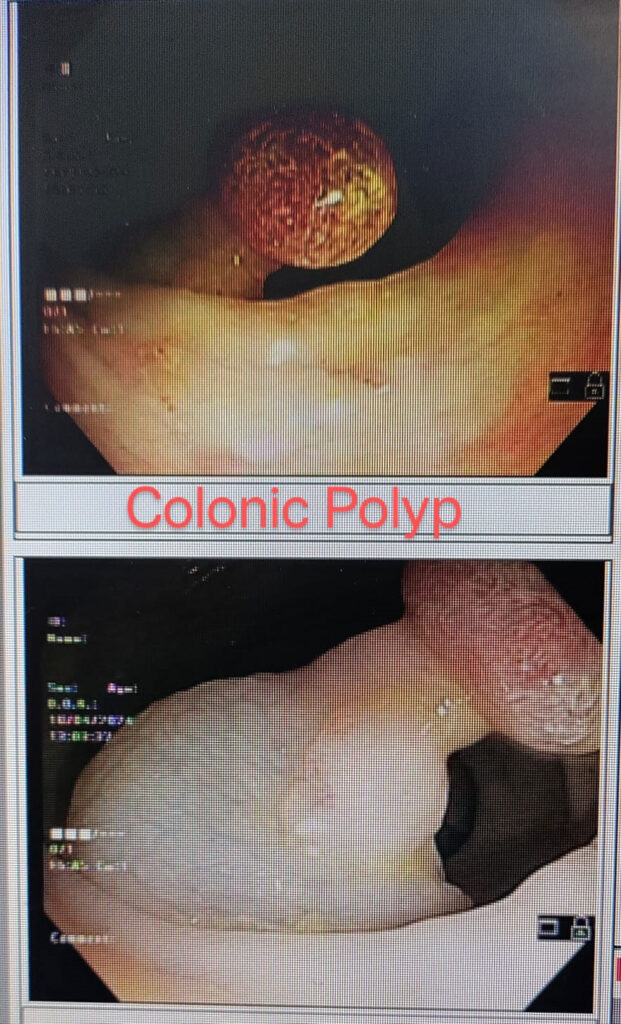 colonic polyp