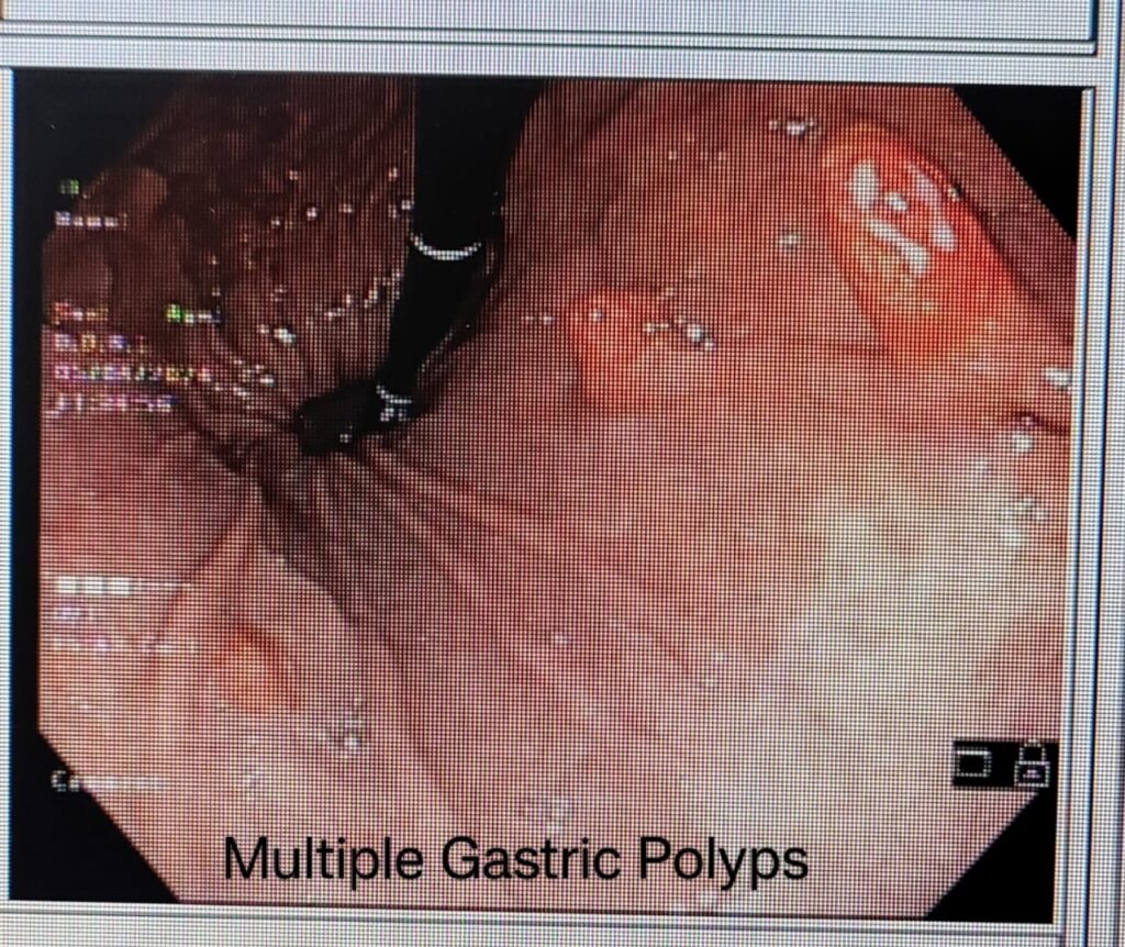 Multiple Gastric Polyps