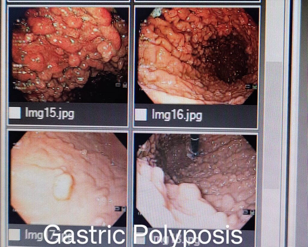 gastric polyposis