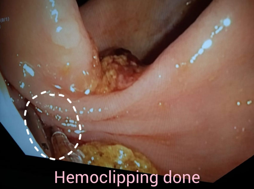 hemoclipping
