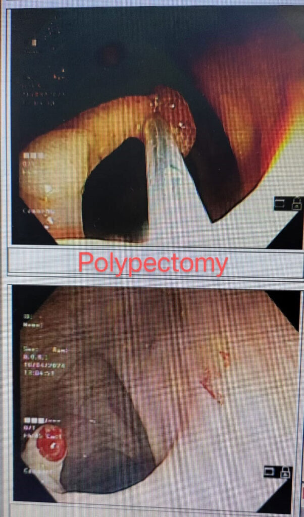 polypectomy