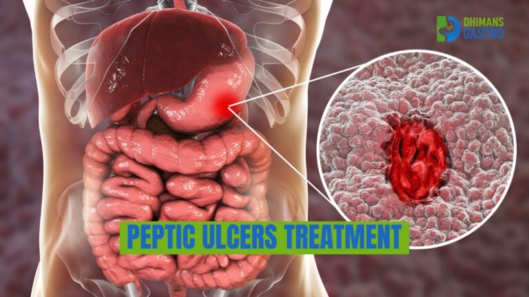 Ulcer treatment Khanna | Peptic ulcers treatment in khanna | Best ...