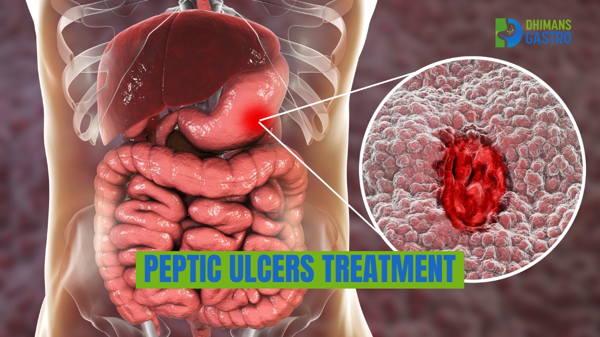 peptic ulcers treatment